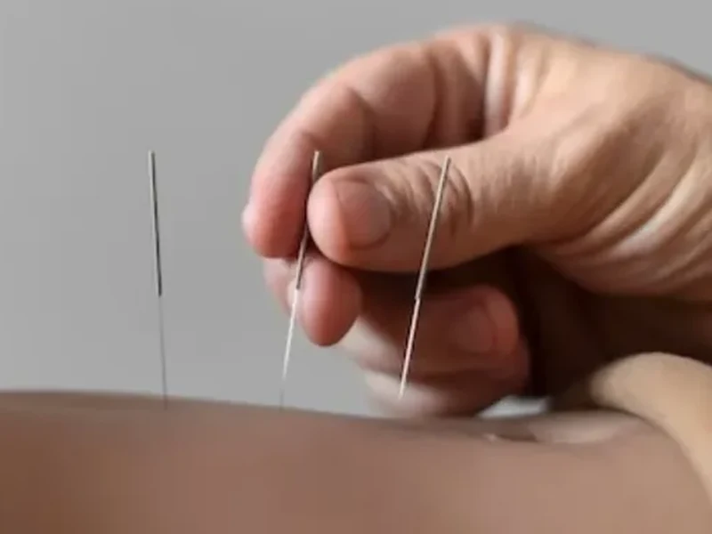 Close-up of a clinician's hand placing thin dry needling needles along a patient's lower back