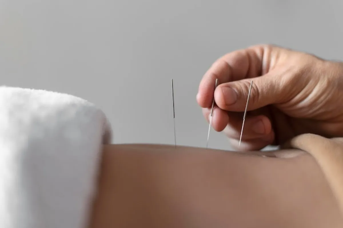 dry needling (2)